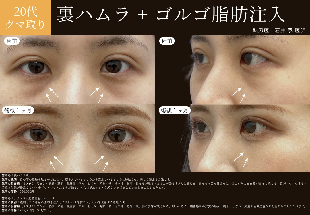 裏ハムラ法